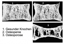 Osteoporose vorbeugen oder behandeln mit Mikronährstoffen Osteoporose