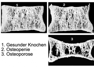 Osteoporose vorbeugen oder behandeln mit Mikronährstoffen Osteoporose