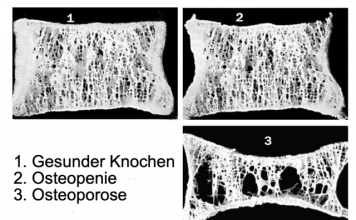 Osteoporose vorbeugen oder behandeln mit Mikronährstoffen Osteoporose