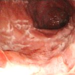 Der chronisch entzündliche Darm morbus crohn