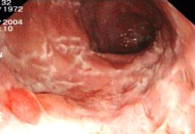 Der chronisch entzündliche Darm morbus crohn