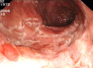 Der chronisch entzündliche Darm morbus crohn