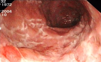 Der chronisch entzündliche Darm morbus crohn