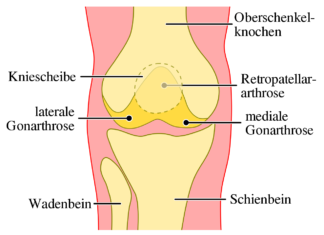 Arthrose und Knorpelregeneration
