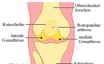 Arthrose und Knorpelregeneration