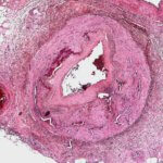 Chelat-Therapie bei Atherosklerose