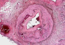 Chelat-Therapie bei Atherosklerose