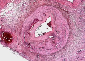Chelat-Therapie bei Atherosklerose