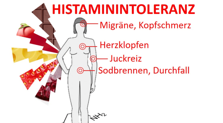 Histaminose: Ursache Vieler Beschwerden - Komplementärmedizin Felber