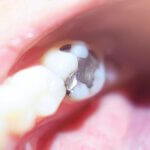 Amalgamsanierung amalgam