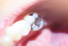 Amalgamsanierung amalgam