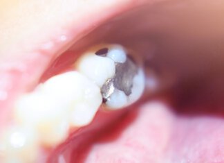 Amalgamsanierung amalgam