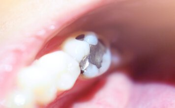 Amalgamsanierung amalgam